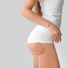 Young,Woman,With,Cellulite,Problem,On,Light,Background